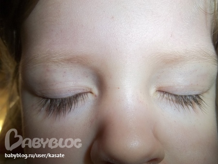 Красно-синие точки вокруг глаз??? — 45 ответов | форум Babyblog