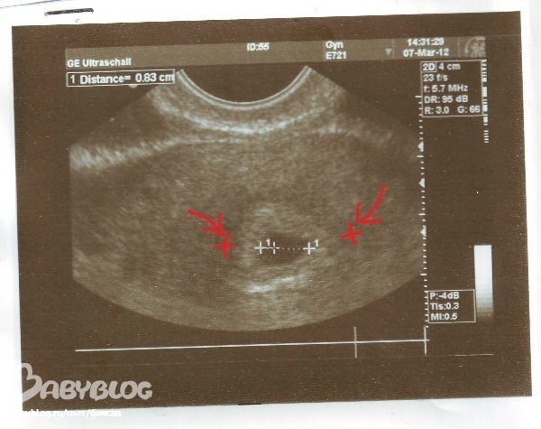 Эндометрий 3 2. УЗИ беременности 4 недели эндометрия. УЗИ беременности 5 недель эндометрий. Эндометрий 4 3 мм на УЗИ. Эндометрий при ранней беременности на УЗИ.