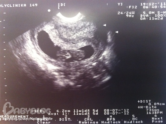 Тонус 8 недель. Тонус матки при беременности 1 триместр УЗИ. Гипертонус матки при беременности 2 триместр УЗИ. Гипертонус матки при беременности 1 триместр УЗИ.
