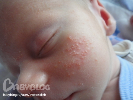 Акне новорожденных (acne neonatorum)