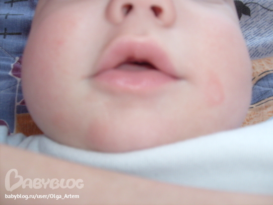Сухая кожа у младенцев: что делать? – статьи о здоровье