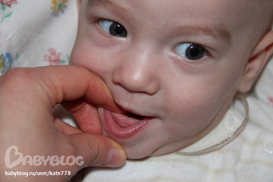 Прорезывание Зубов У Детей Фото Десны