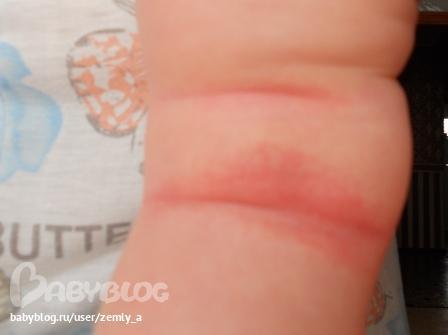Аллергия у ребенка под коленками красные пятна thumbnail