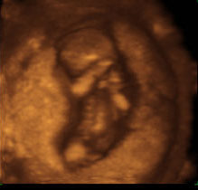 Плод 11 недель фото. 3д УЗИ 11 недель беременности. Зародыш 11 недель УЗИ. УЗИ 11 недель беременности.