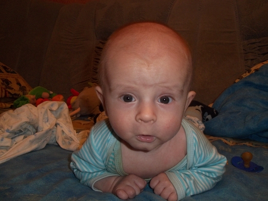 Малышу 3 месяца форум. Форма головы у детей при внутричерепном давлении.