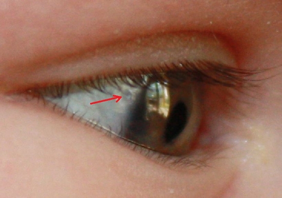Герпес на глазу (офтальмогерпес) – симптомы, причины, диагностика и лечение в «СМ-Клиника»
