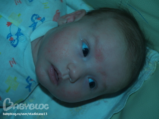 Красная сыпь на лице новорожденного