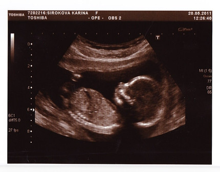 Норма в 17 недель. УЗИ 17 недель беременности. УЗИ плода 17 недель беременности. 17 Недель беременности фото плода на УЗИ. Снимок УЗИ на 17 неделе беременности.