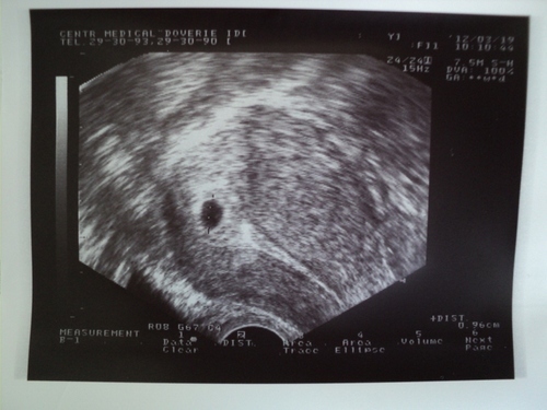 Фото узи 5 недель беременности с подробным описанием