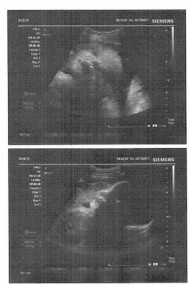 Фото УЗИ на 38 неделе беременности